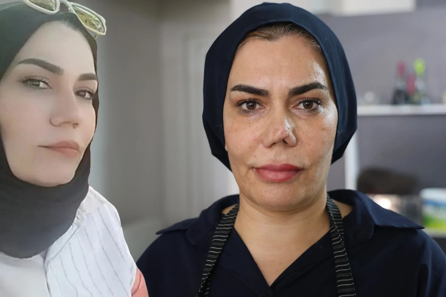 Burun Estetigi Faciayla Sonuclandi Kadinin Hayati Kabusa Dondu 20157819 48 Jpg