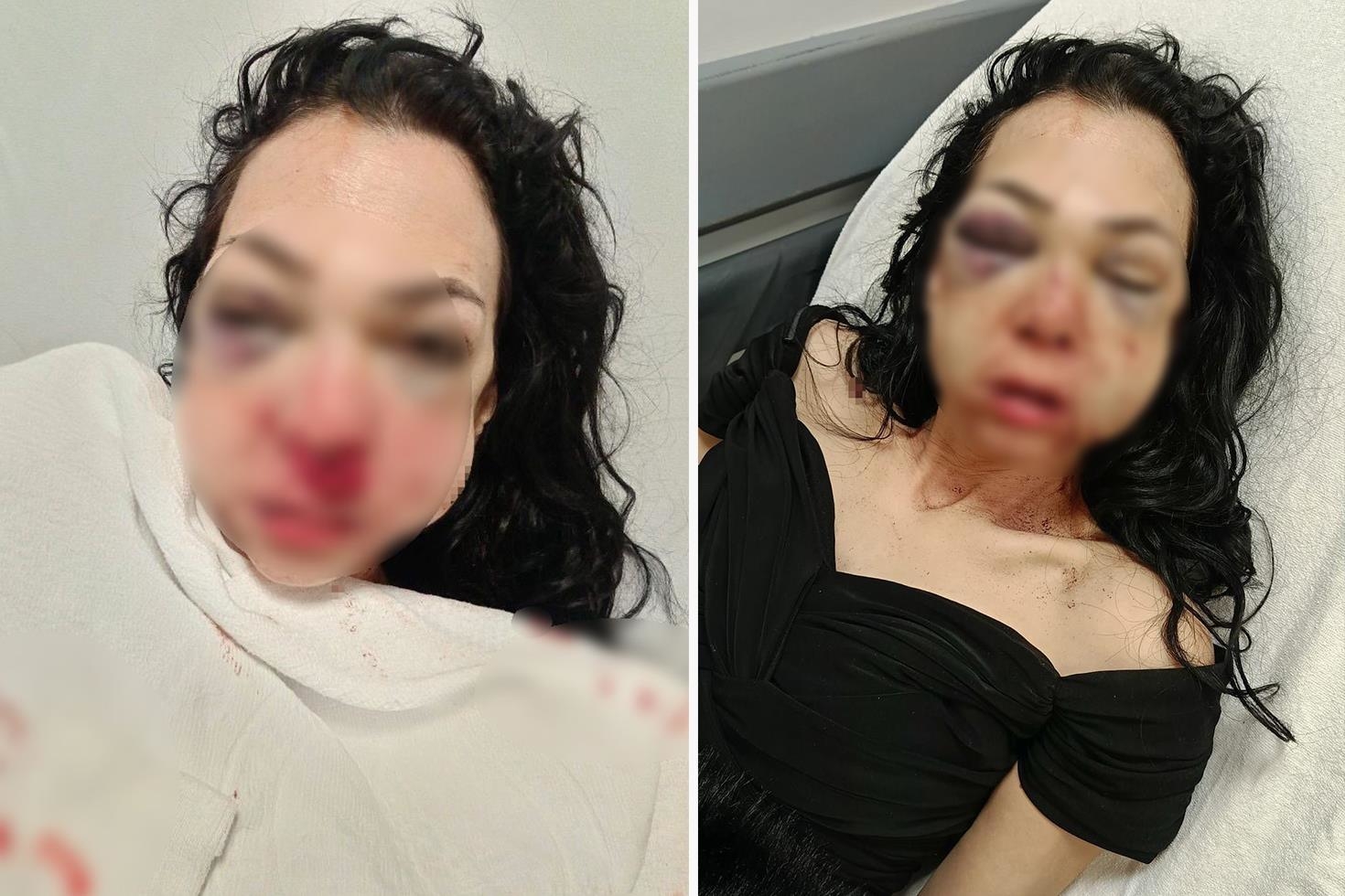 Bayram günü kadının yüzünü bardak ve kül tablasıyla kırmıştı: Tutuklandı